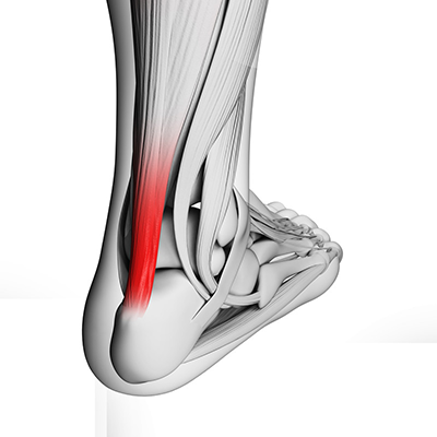 Achilles Tendinopathy