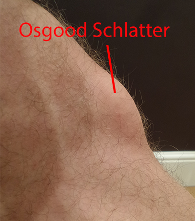 Osgood-Schlatter