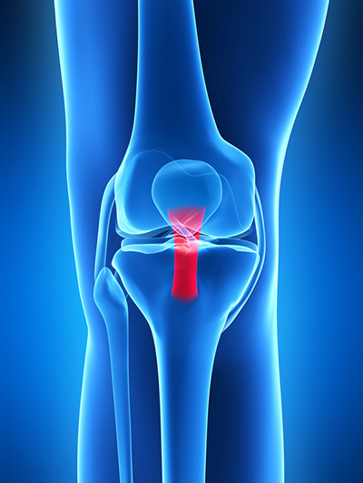 Patella Tendinopathy