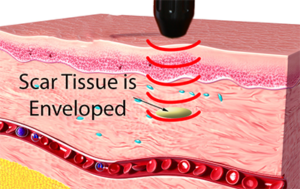 Shockwave Dissection Biological Effects of Radial Shockwave – Shockwave Therapy