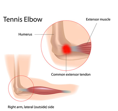 Tennis / Golfer’s Elbow